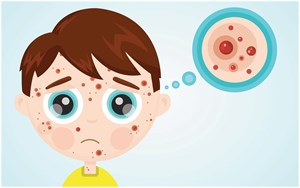 پاورپوینت مراقبت بیماری سرخجه و سندرم سرخجه مادرزادی