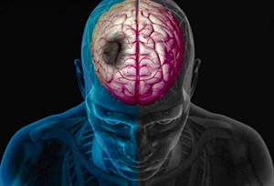پاورپوینت سکته‌ مغزی‌