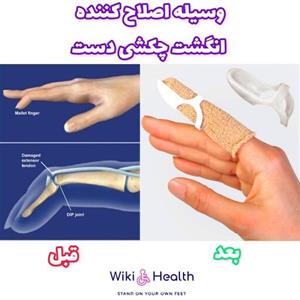 اسپلینت ملت فینگر (انگشت چکشی) (طب و صنعت) (ویکی هلث)