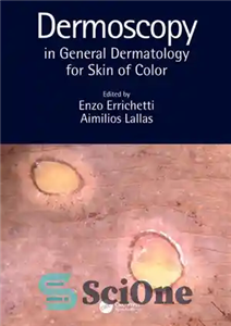 دانلود کتاب Dermoscopy in General Dermatology for Skin of Color – درموسکوپی در درماتولوژی عمومی برای پوست رنگی