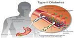 مقاله و مبانی نظری دیابت نوع 2