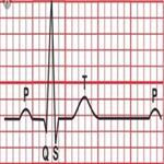 آنالیز سیگنال نوار قلبی و استخراج علائم حیاتی غیرطبیعی آن