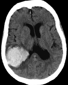 پاورپوینت ارزیابی خون ریزی های مغزی در MRI