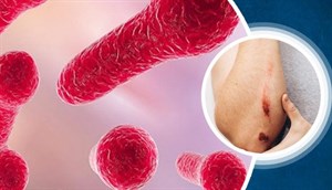 پاورپوینت تشریح بیماری کزاز Tetanus
