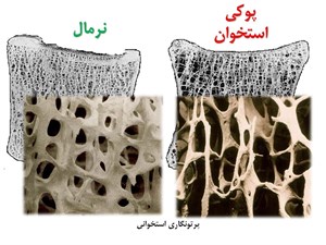 پاورپوینت مبانی پوکی استخوان