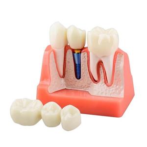 مولاژ ایمپلنت، تاج و بریج دندان