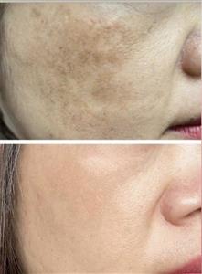 کرم ضد لک و آکنه بیوممتیک اصلی اورجینال ویتامین سی گاتیو فرانسه