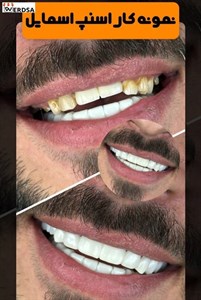  لمینت و کامپوزیت دندان اسنپ اسمایل snap on smile برای دو فک اصلی 