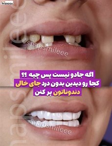 لمینت دندان snap on smile برای خرابی 10 دندان(شرکت وردسا)