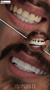 لمینت دندان snap on smile برای خرابی 2 دندان شرکت وردسا